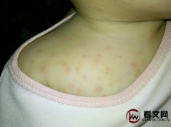 婴儿湿疹是什么病？常见吗？
