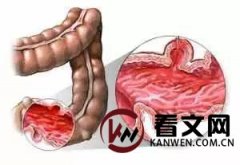 溃疡性结肠炎常见的几种症状表现，你都知道吗？