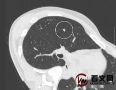 肺结节浅分叶早期手术能治好吗