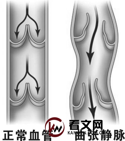 静脉曲张