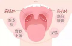 扁桃体发炎喝淡盐水有用吗