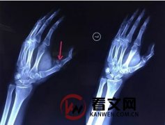 手指骨折如何康复