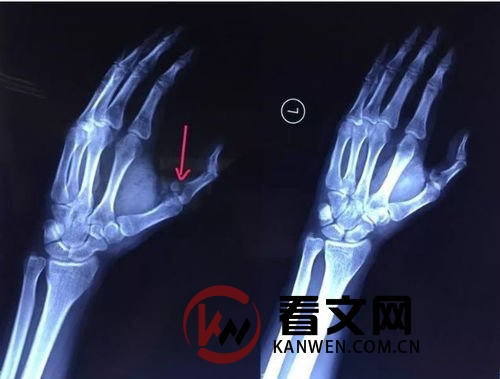 手指骨折如何康复
