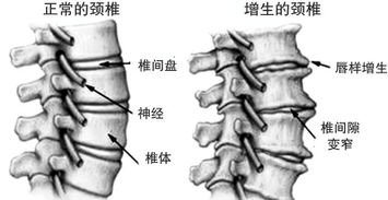 颈椎骨质增生伴生理强直怎么办